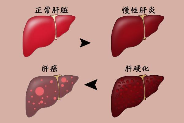 开云 开云体育77岁院士呼吁：停止饮用1“茶叶”或比烟酒还伤肝建议早处理(图2)